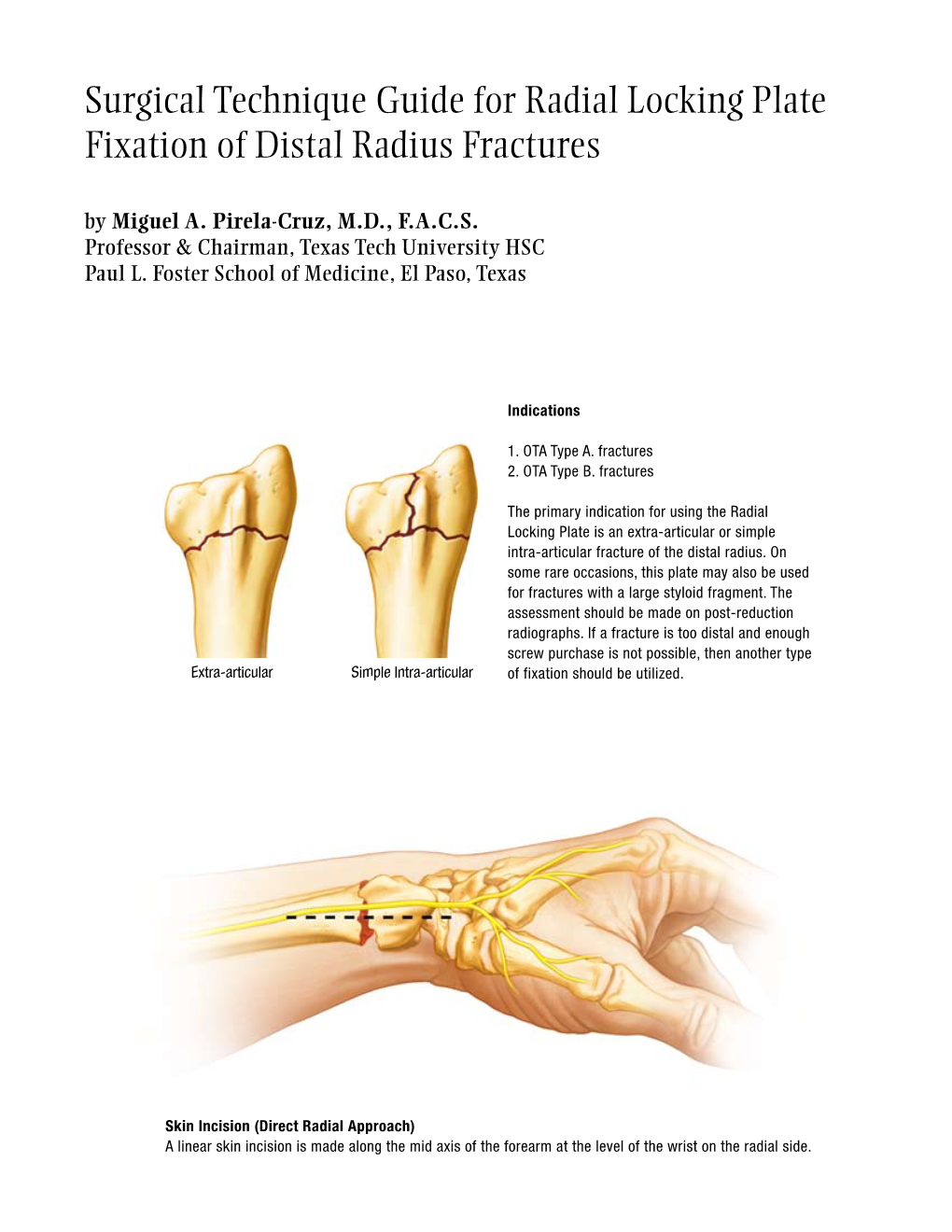 Surgical Technique Guide for Radial Locking Plate Fixation of Distal Radius Fractures by Miguel A