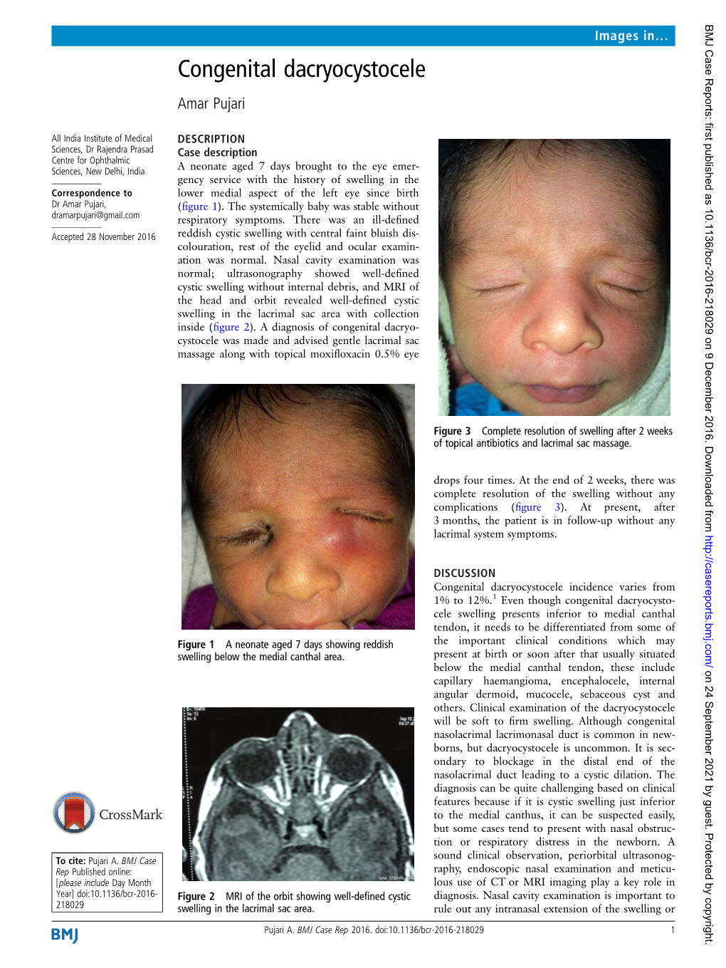 Congenital Dacryocystocele Amar Pujari