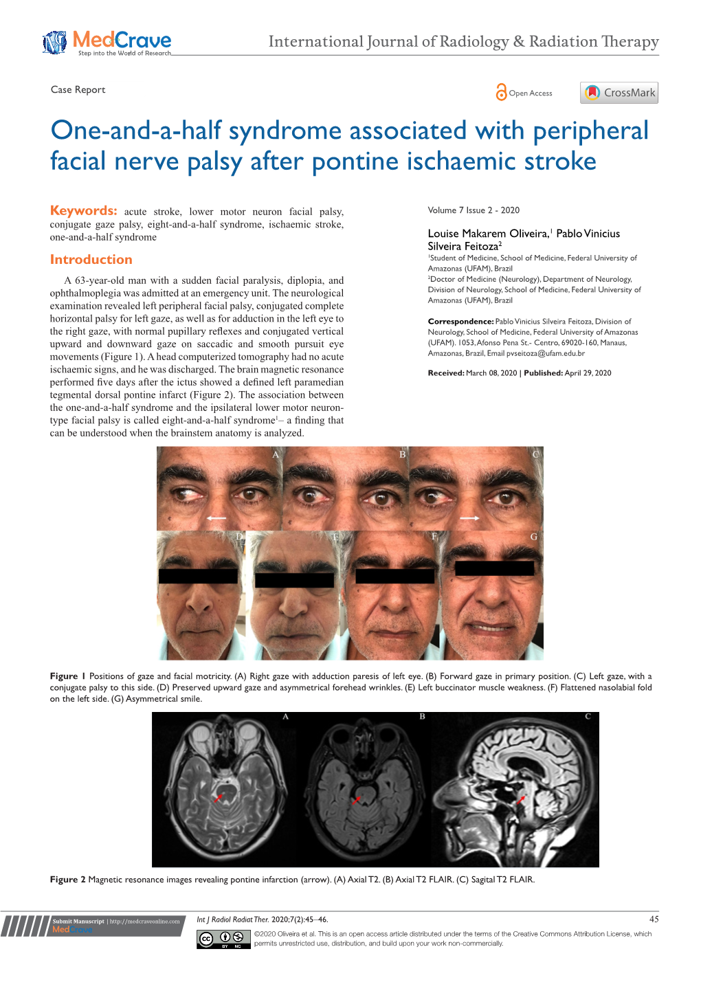 One-And-A-Half Syndrome Associated with Peripheral Facial Nerve Palsy After Pontine Ischaemic Stroke