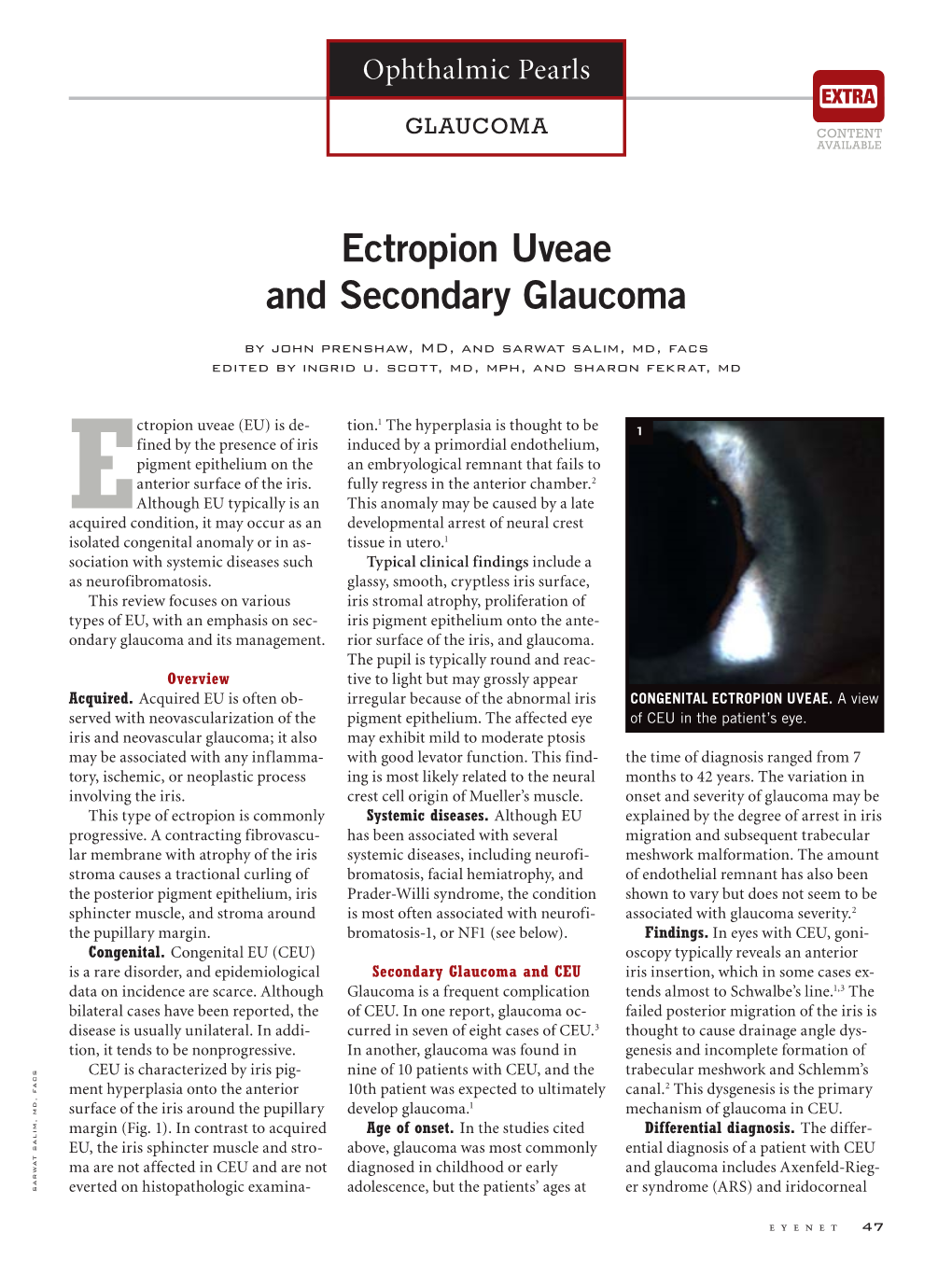 Ectropion Uveae and Secondary Glaucoma