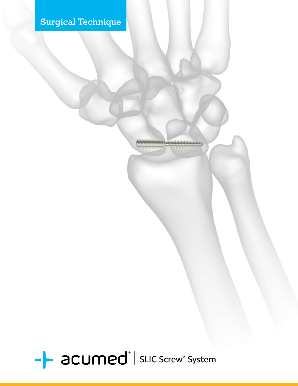 SLIC Screw® System Surgical Technique System Features SL Targeting Guide
