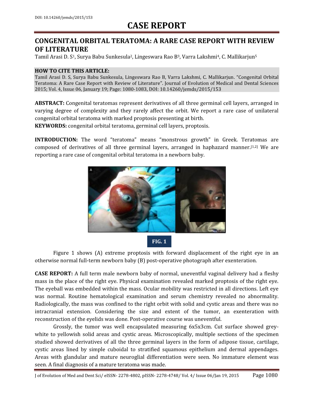 CASE REPORT CONGENITAL ORBITAL TERATOMA: a RARE CASE REPORT with REVIEW of LITERATURE Tamil Arasi D