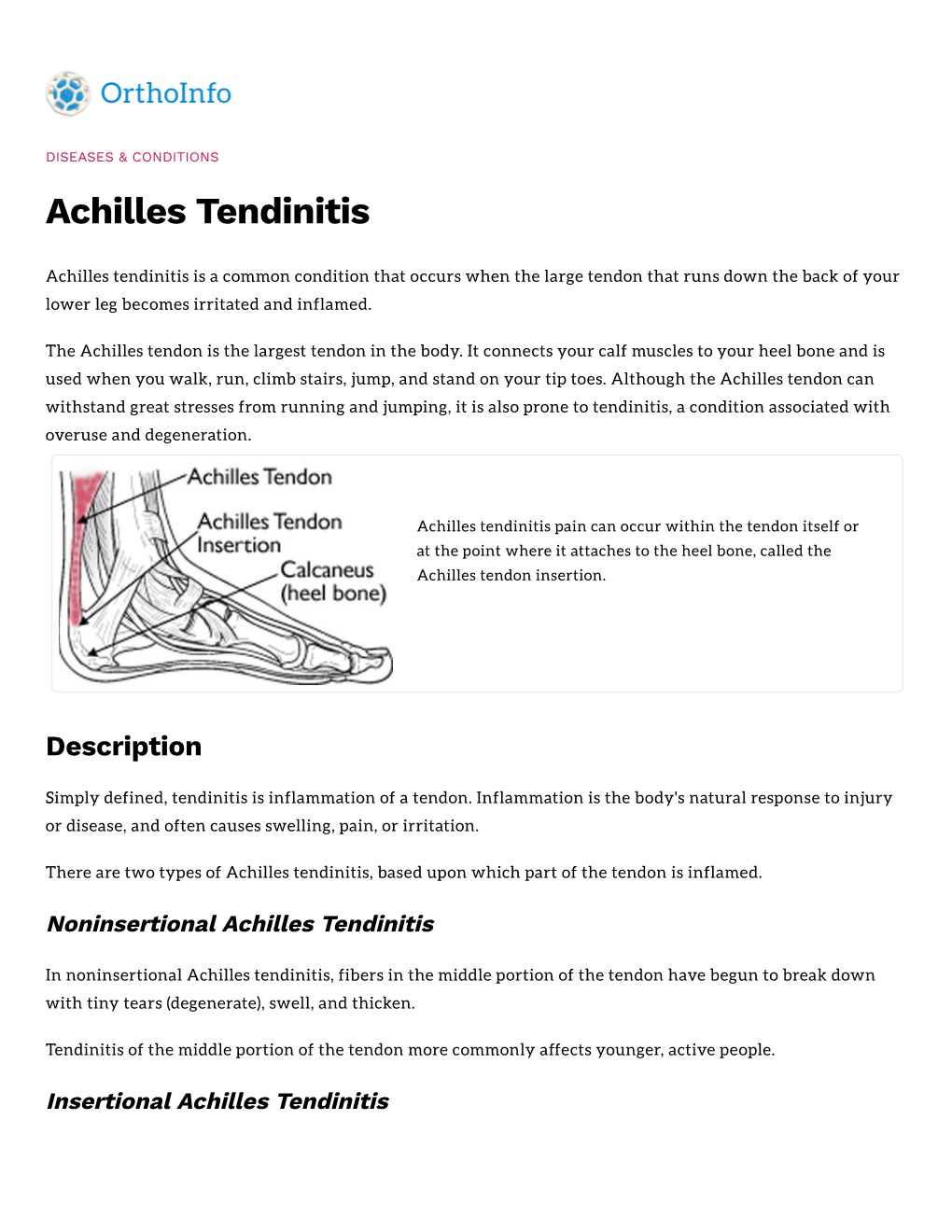 Achilles Tendinitis