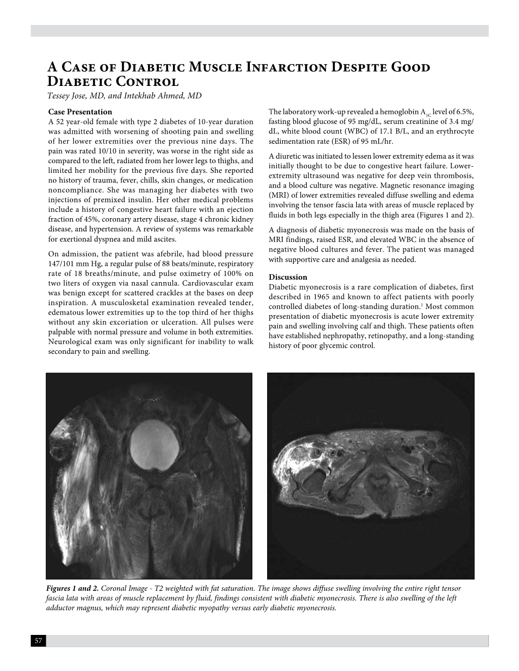 A Case of Diabetic Muscle Infarction Despite Good Diabetic Control Tessey Jose, MD, and Intekhab Ahmed, MD