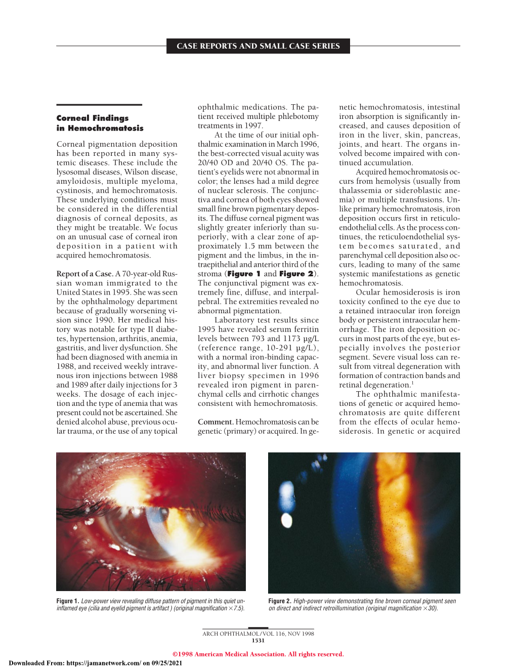 Corneal Findings in Hemochromatosis