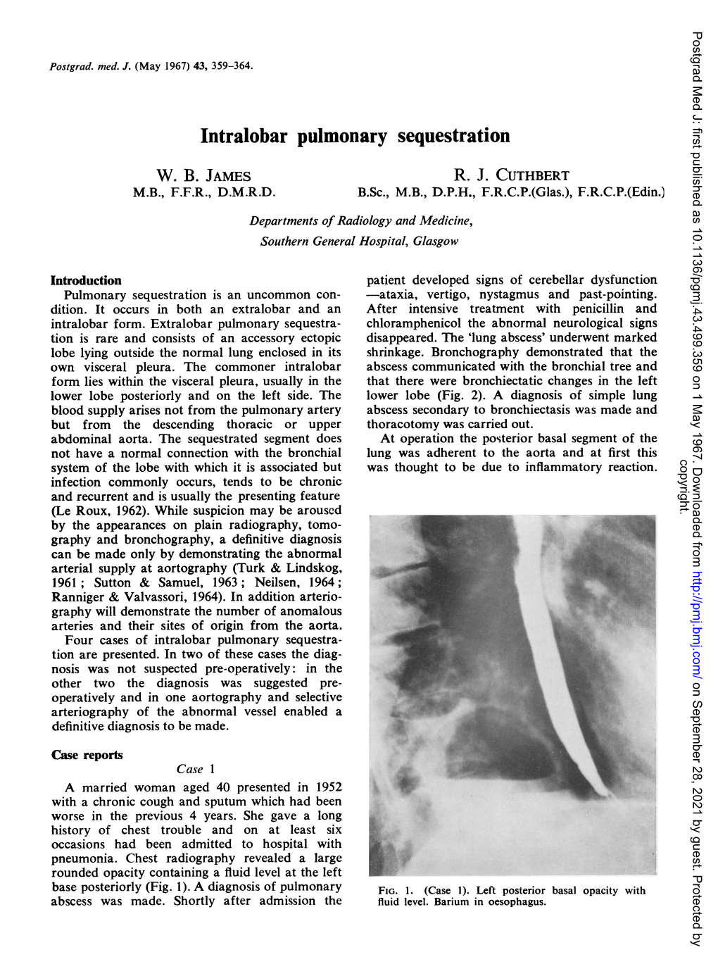 Intralobar Pulmonary Sequestration W