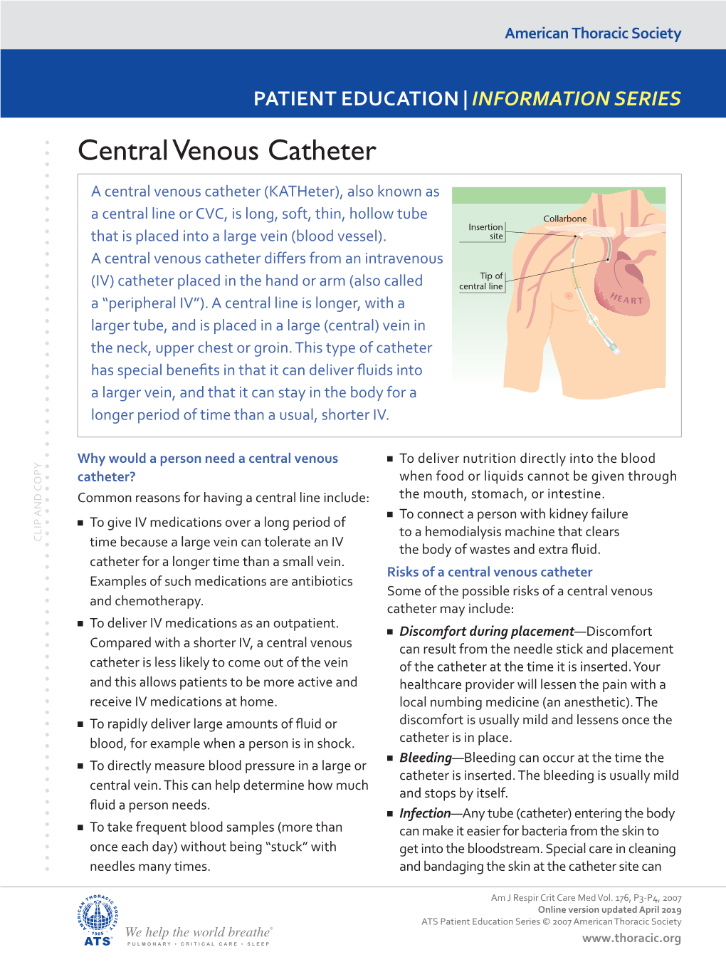 Central Venous Catheter (Central Line)