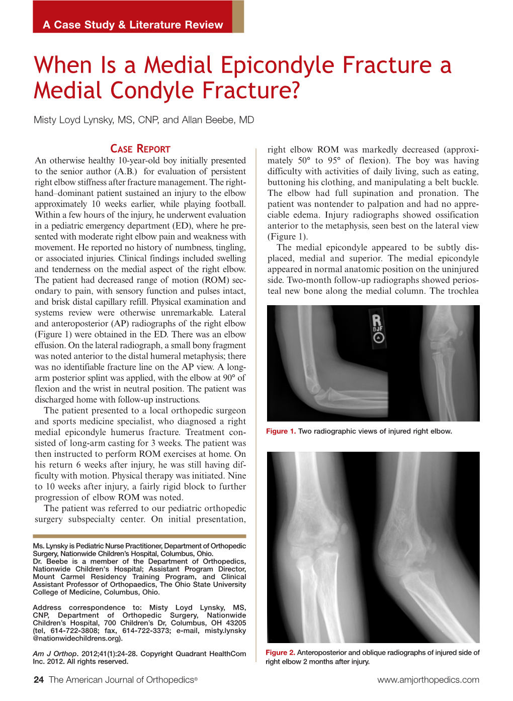 When Is a Medial Epicondyle Fracture a Medial Condyle Fracture?