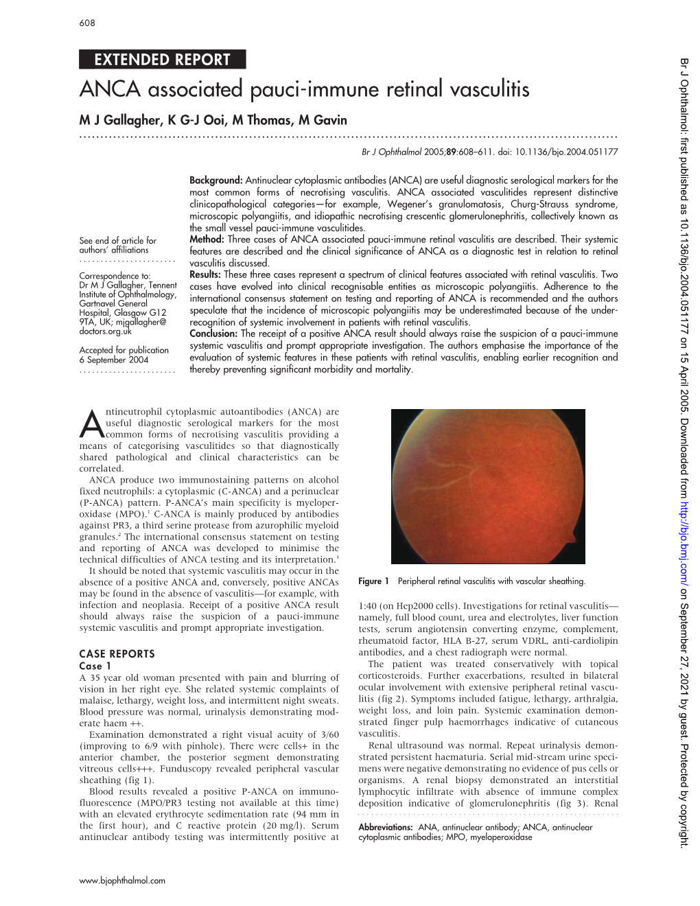 ANCA Associated Pauci-Immune Retinal Vasculitis M J Gallagher, K G-J Ooi, M Thomas, M Gavin