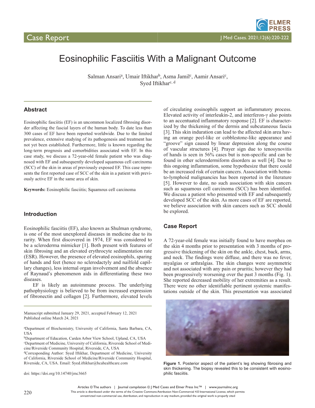 Eosinophilic Fasciitis with a Malignant Outcome