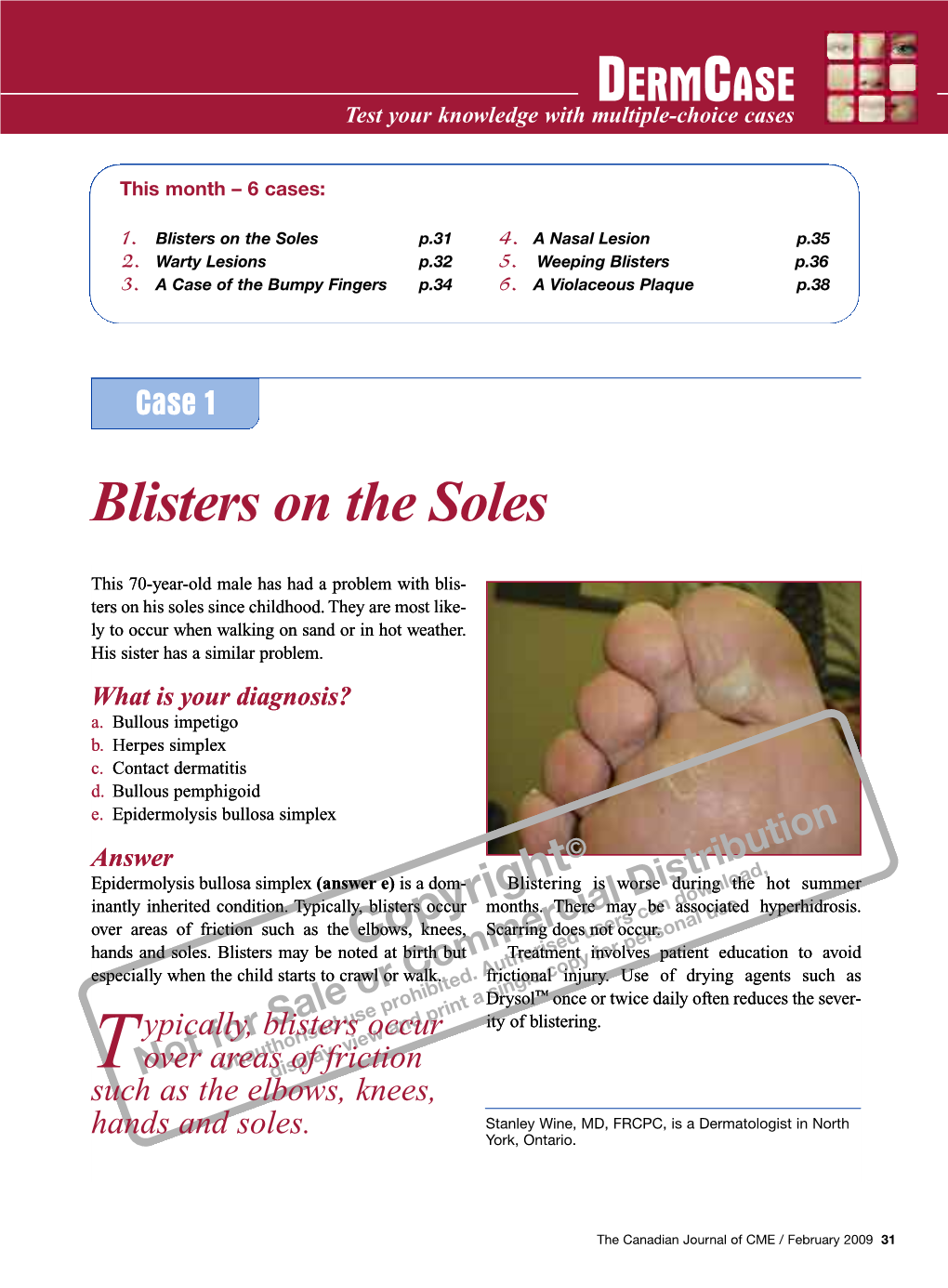 Blisters on the Soles P.31 4