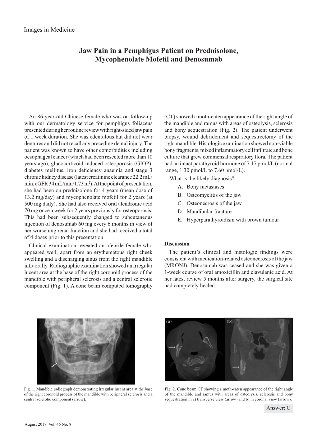 Jaw Pain in a Pemphigus Patient on Prednisolone, Mycophenolate Mofetil and Denosumab