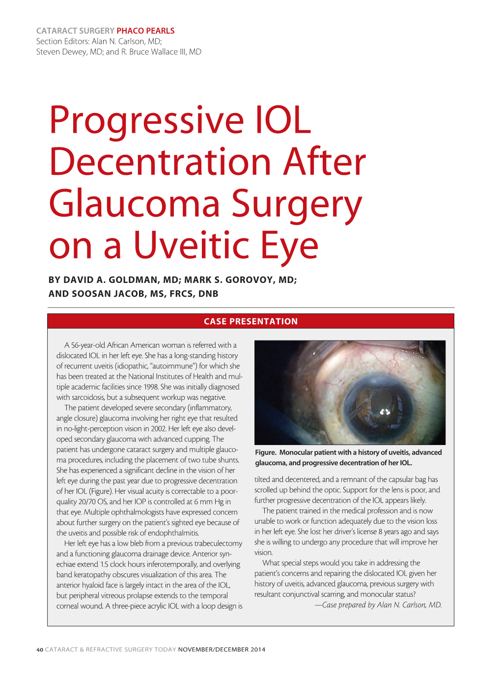 Progressive IOL Decentration After Glaucoma Surgery on a Uveitic Eye by DAVID A