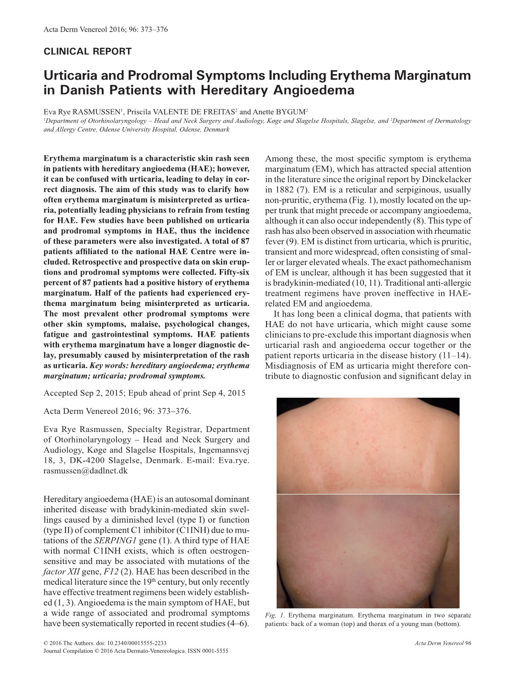 Urticaria and Prodromal Symptoms Including Erythema Marginatum in Danish Patients with Hereditary Angioedema