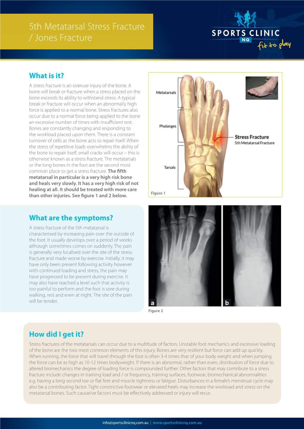 5Th Metatarsal Stress Fracture / Jones Fracture