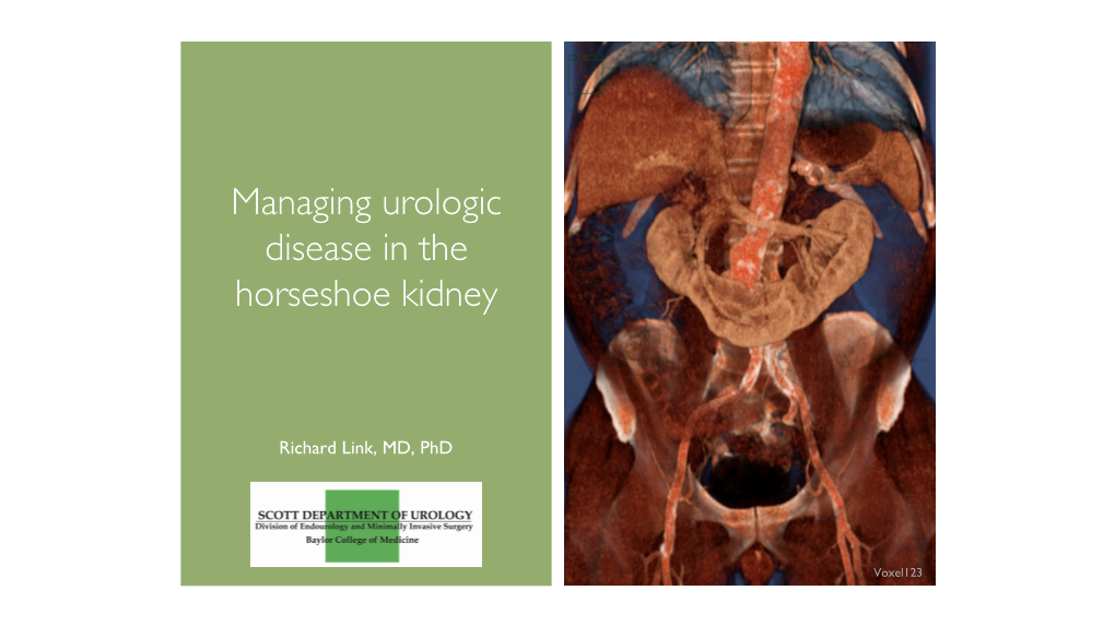 Managing Urologic Disease in the Horseshoe Kidney