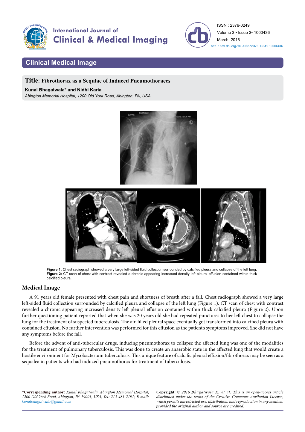 Fibrothorax As a Sequlae of Induced Pneumothoraces Kunal Bhagatwala* and Nidhi Karia Abington Memorial Hospital, 1200 Old York Road, Abington, PA, USA