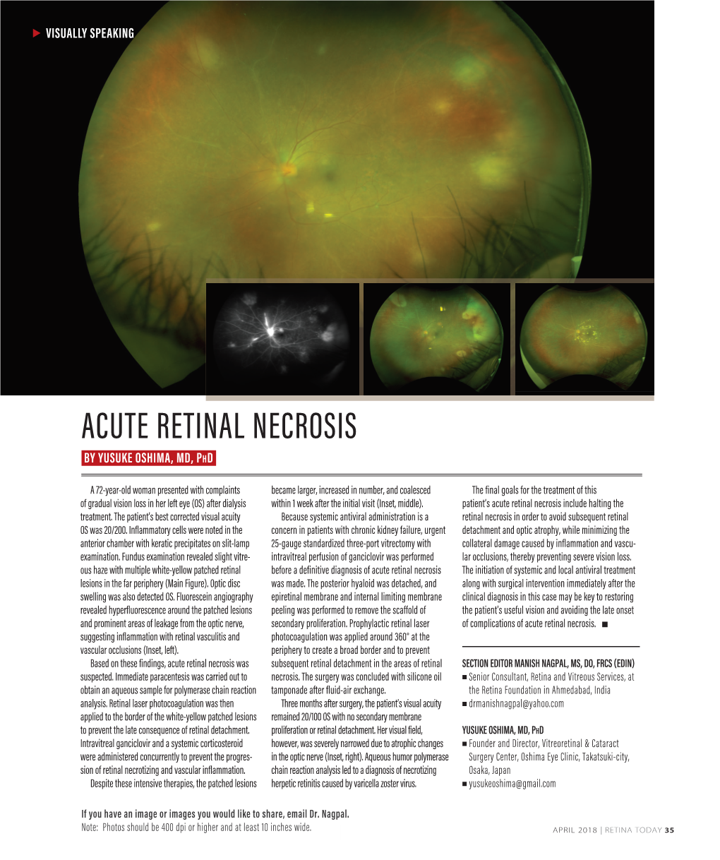 ACUTE RETINAL NECROSIS by YUSUKE OSHIMA, MD, Phd