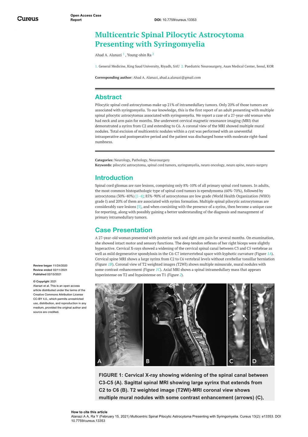 Multicentric Spinal Pilocytic Astrocytoma Presenting with Syringomyelia