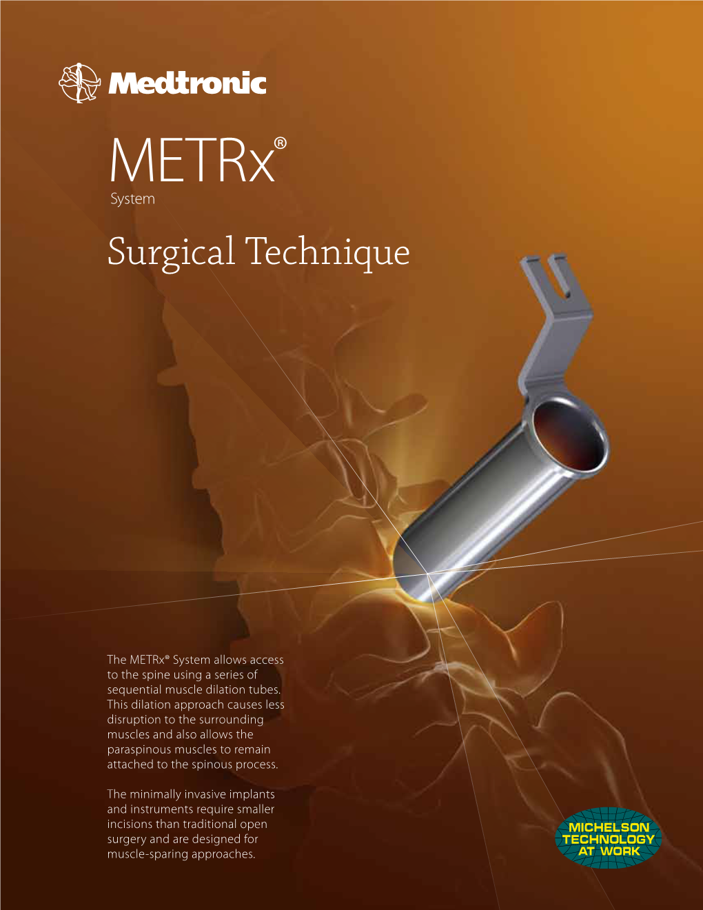 Metrx® System Surgical Technique