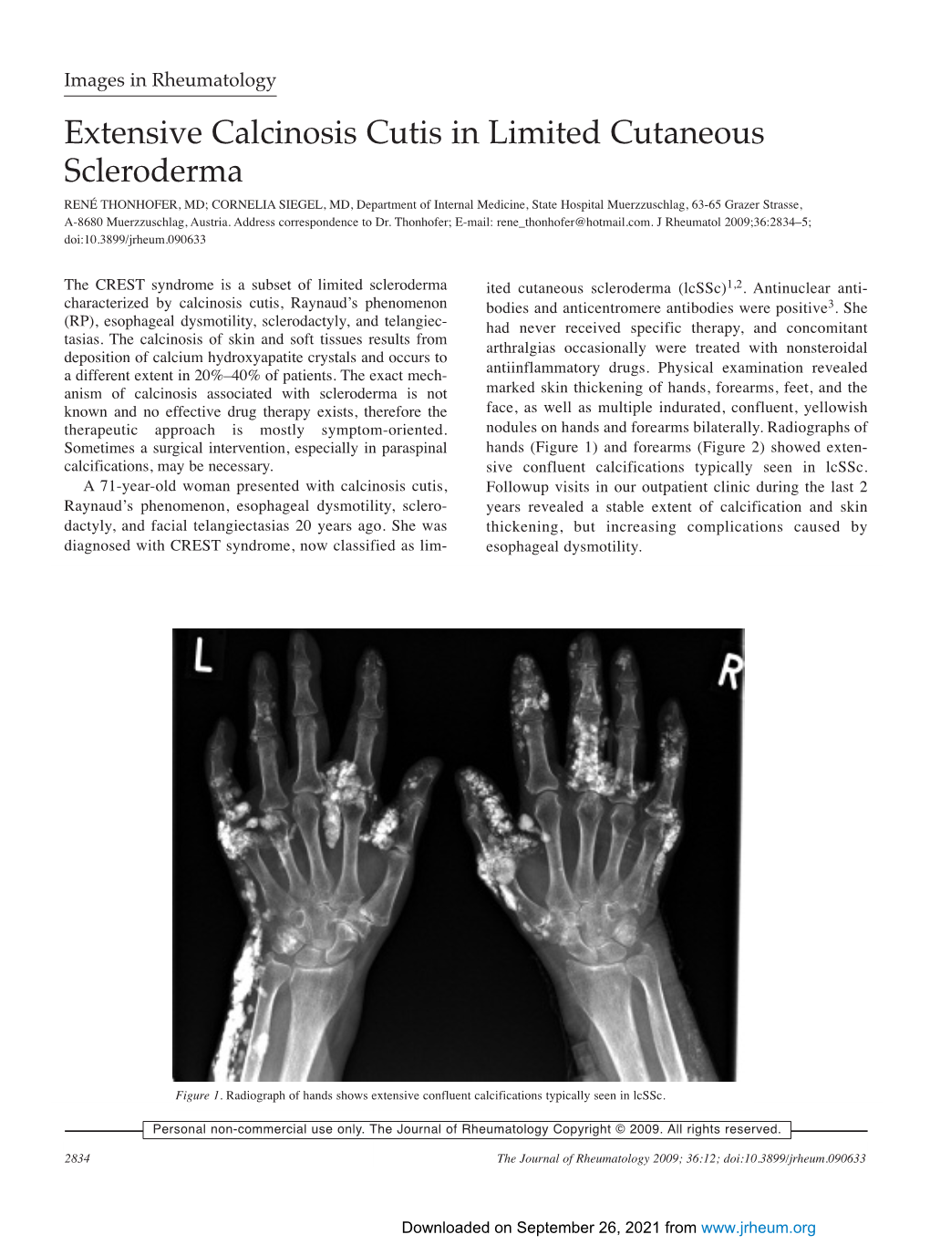 Extensive Calcinosis Cutis in Limited Cutaneous Scleroderma