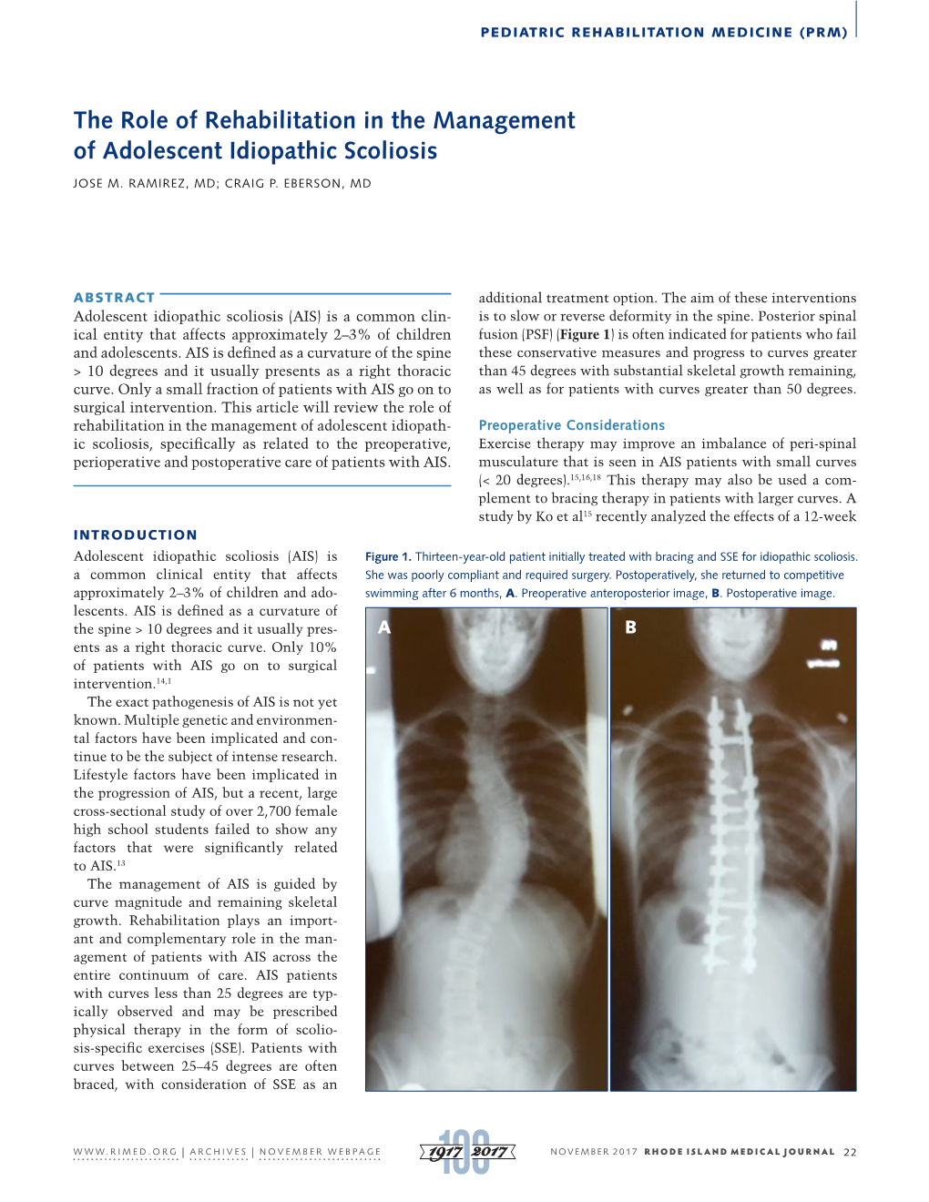 The Role Of Rehabilitation In The Management Of Adolescent Idiopathic Scoliosis Docslib 8196