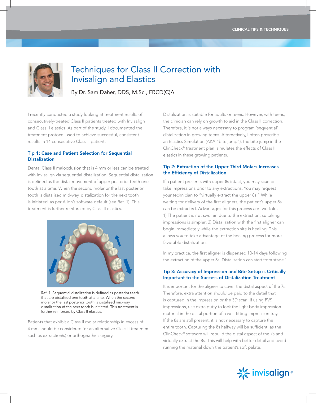 Techniques for Class II Correction with Invisalign and Elastics