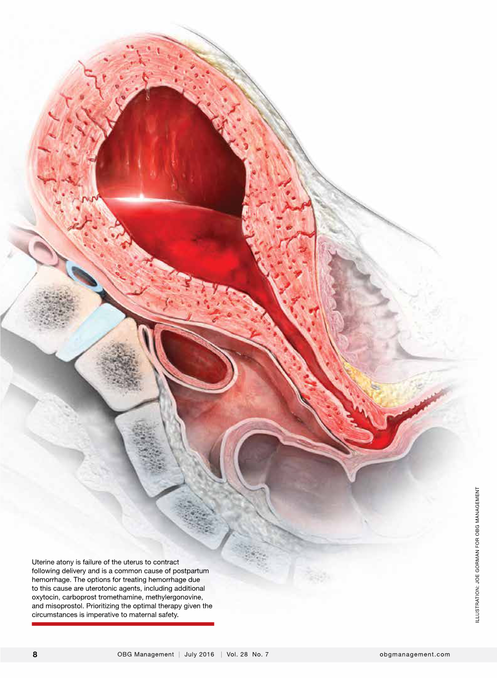 Uterine Atony Is Failure of the Uterus to Contract Following Delivery and Is a Common Cause of Postpartum Hemorrhage