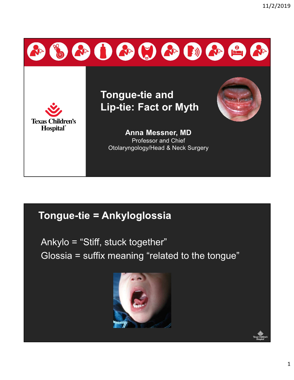 Fact Or Myth Tongue-Tie = Ankyloglossia