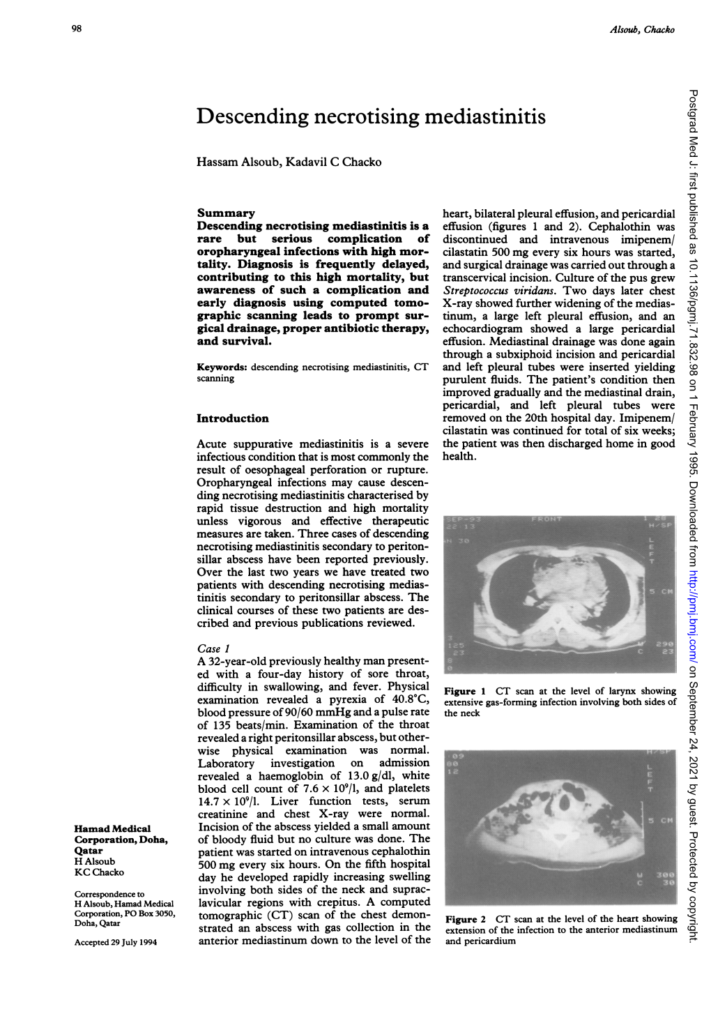 Descending Necrotising Mediastinitis