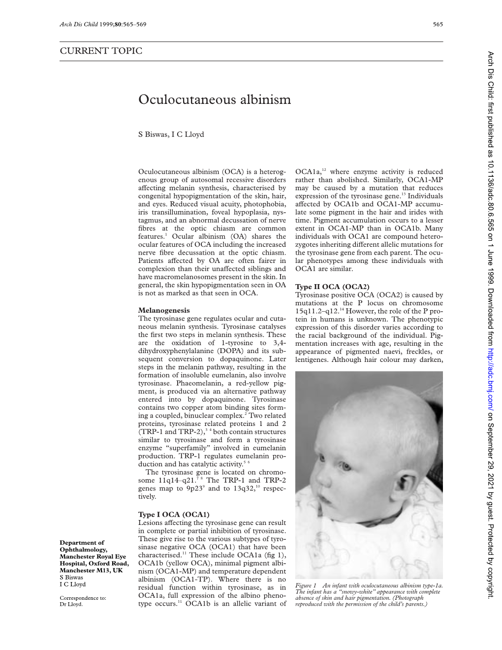 Oculocutaneous Albinism
