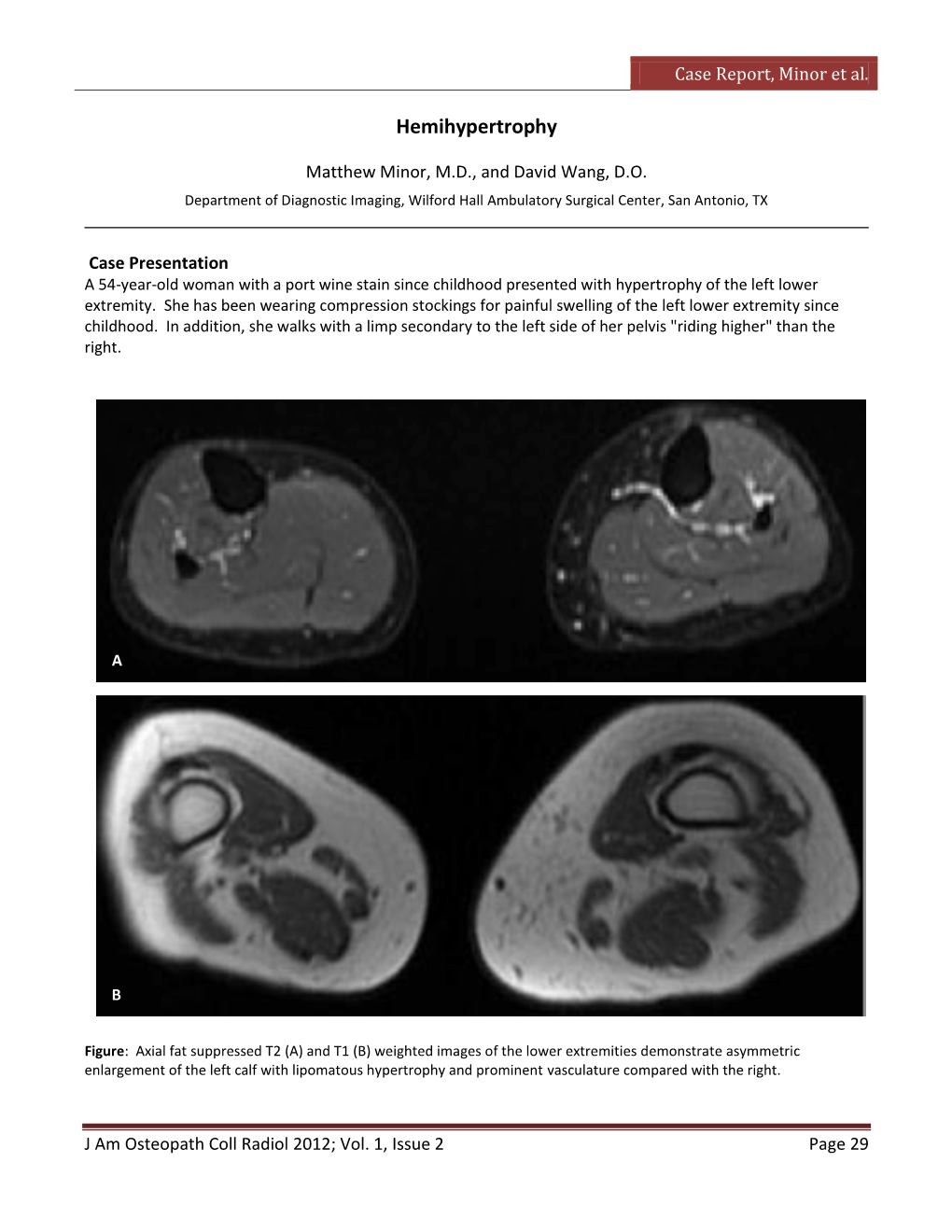 Hemihypertrophy