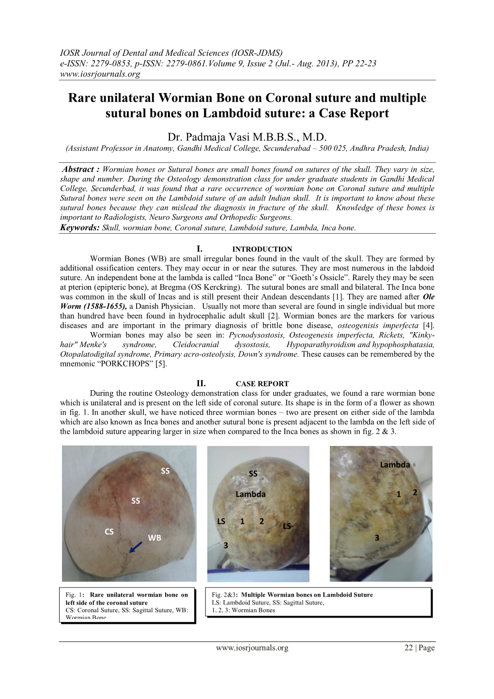 Rare Unilateral Wormian Bone on Coronal Suture and Multiple Sutural Bones on Lambdoid Suture: a Case Report