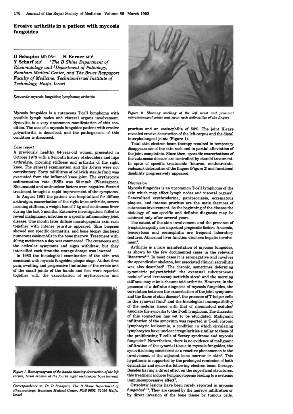 Erosive Arthritis in a Patient with Mycosis Fungoides