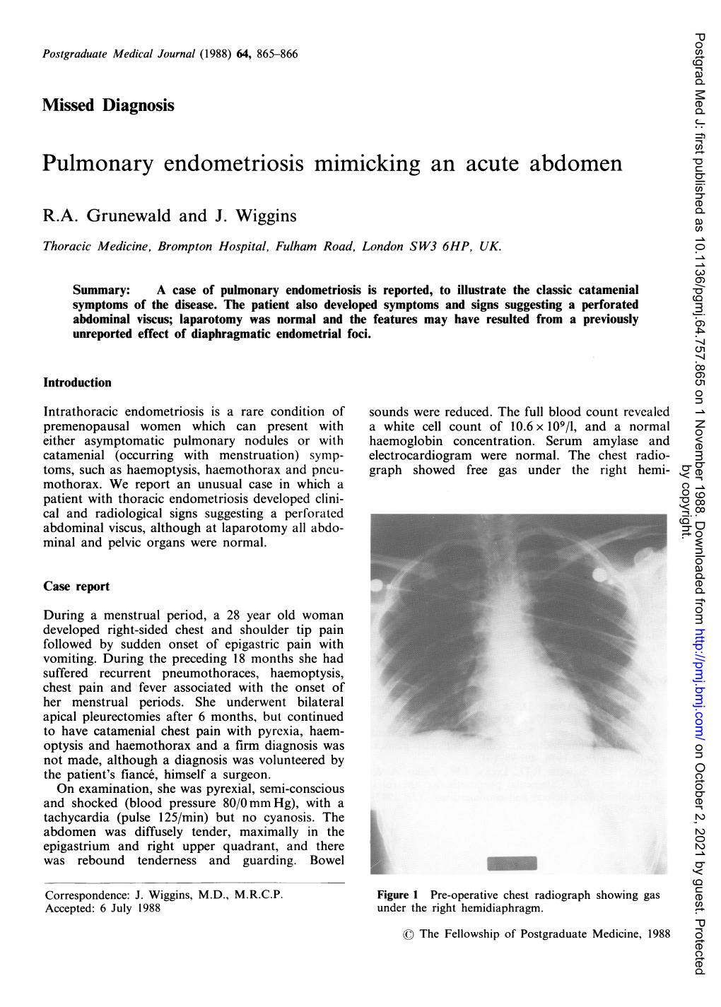 Pulmonary Endometriosis Mimicking an Acute Abdomen