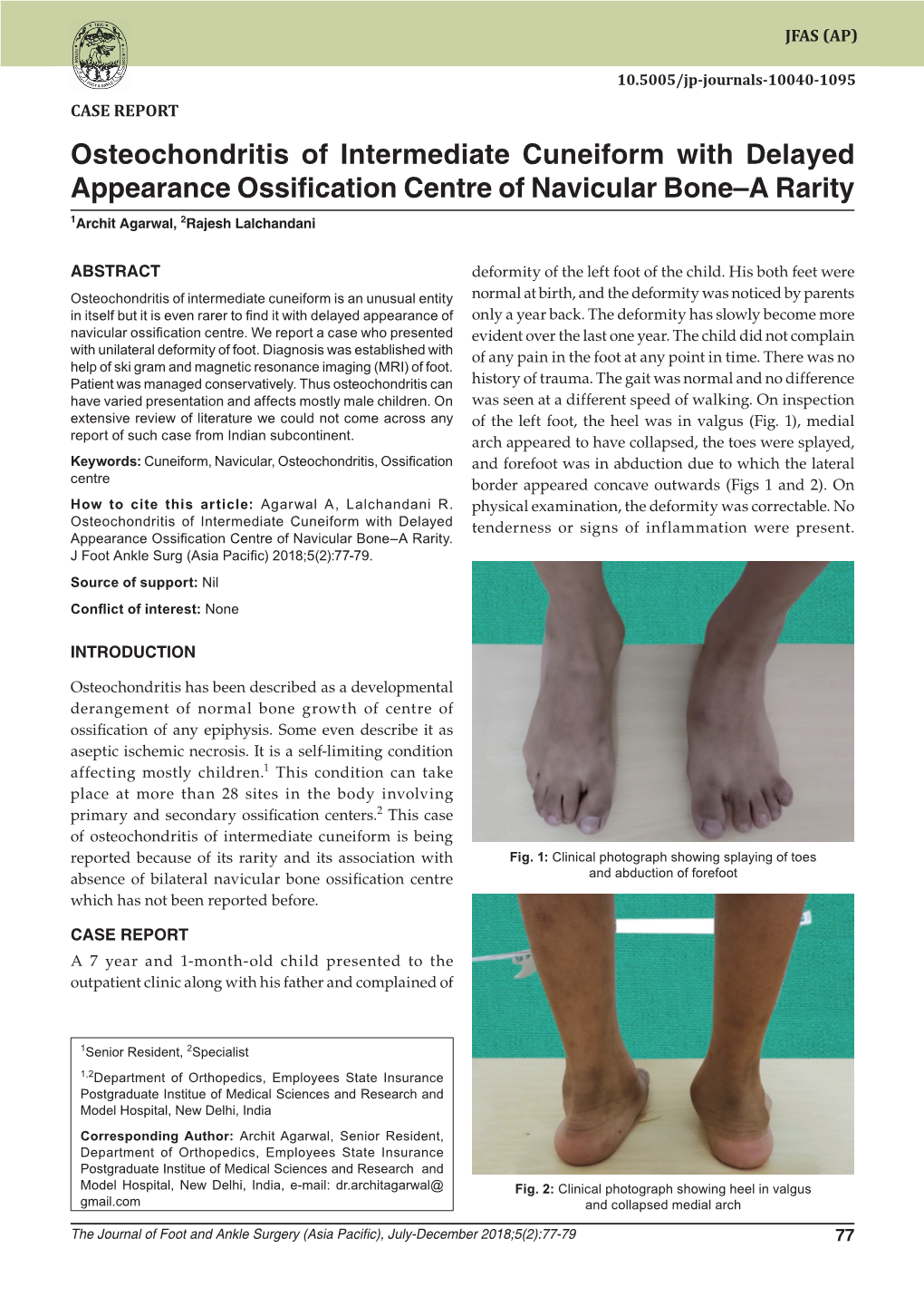 Osteochondritis of Intermediate Cuneiform with Delayed Appearance Ossification Centre of Navicular Bone–A Rarity 1Archit Agarwal, 2Rajesh Lalchandani