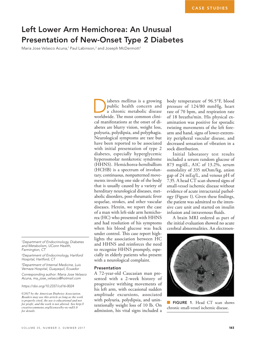 Left Lower Arm Hemichorea: an Unusual Presentation of New-Onset Type 2 Diabetes Maria Jose Velasco Acuna,1 Paul Labinson,2 and Joseph Mcdermott3