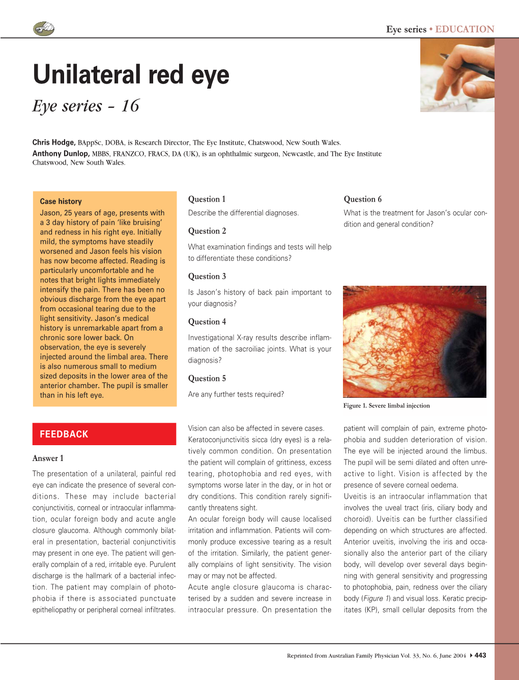 Unilateral Red Eye Eye Series – 16