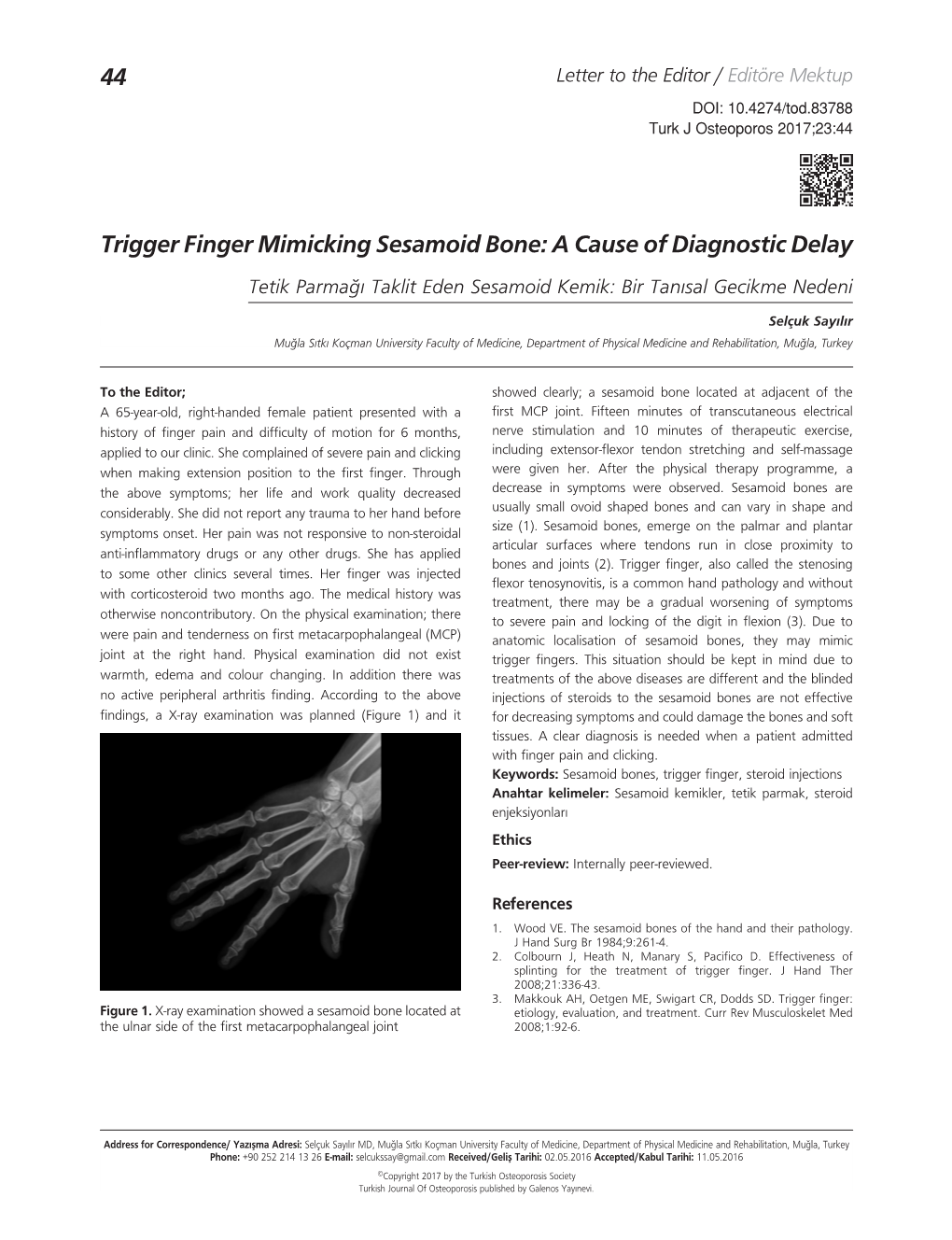 44 Trigger Finger Mimicking Sesamoid Bone