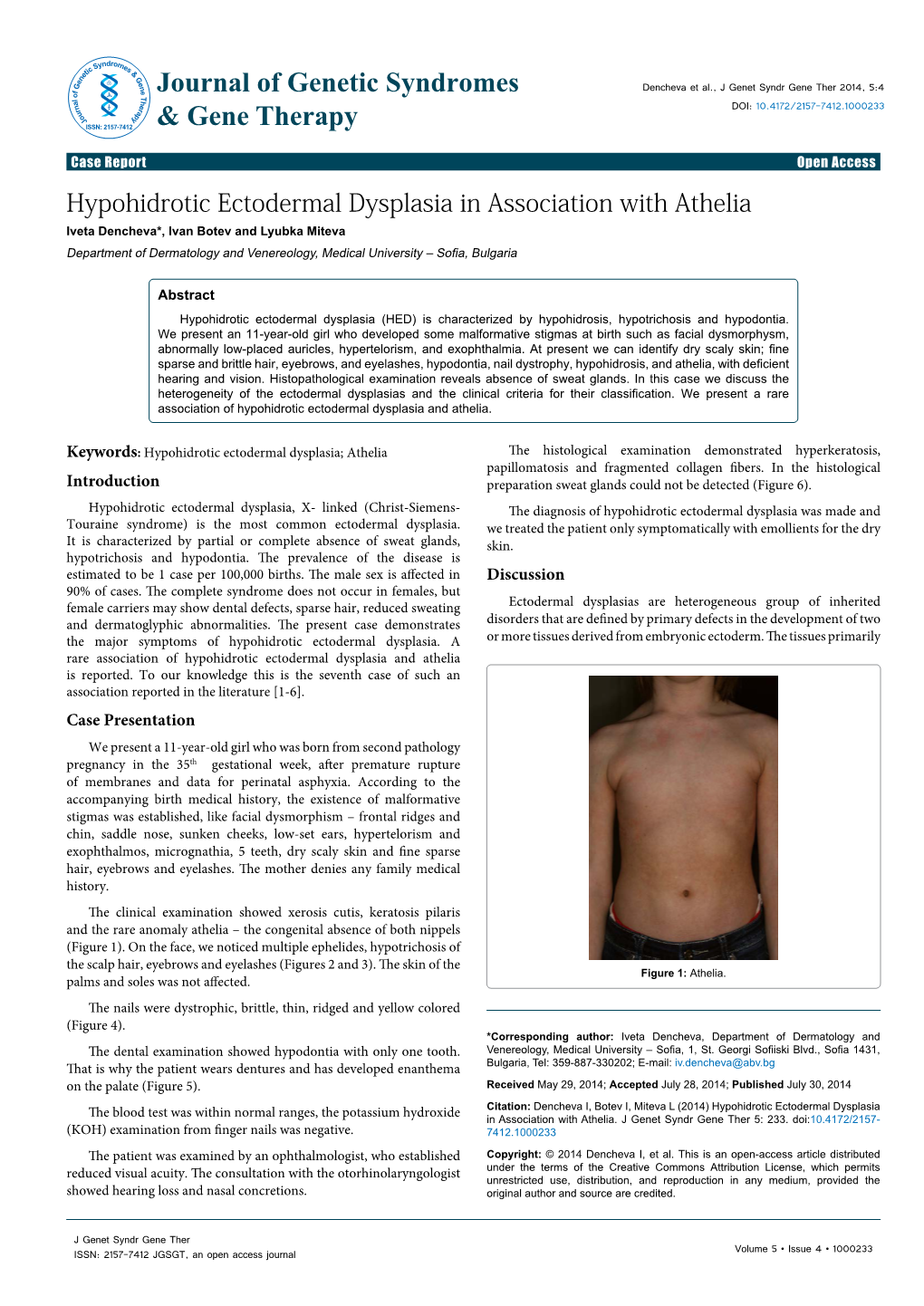 Hypohidrotic Ectodermal Dysplasia in Association with Athelia