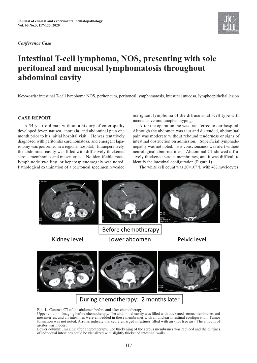 Intestinal T-Cell Lymphoma, NOS, Presenting with Sole Peritoneal and Mucosal Lymphomatosis Throughout Abdominal Cavity