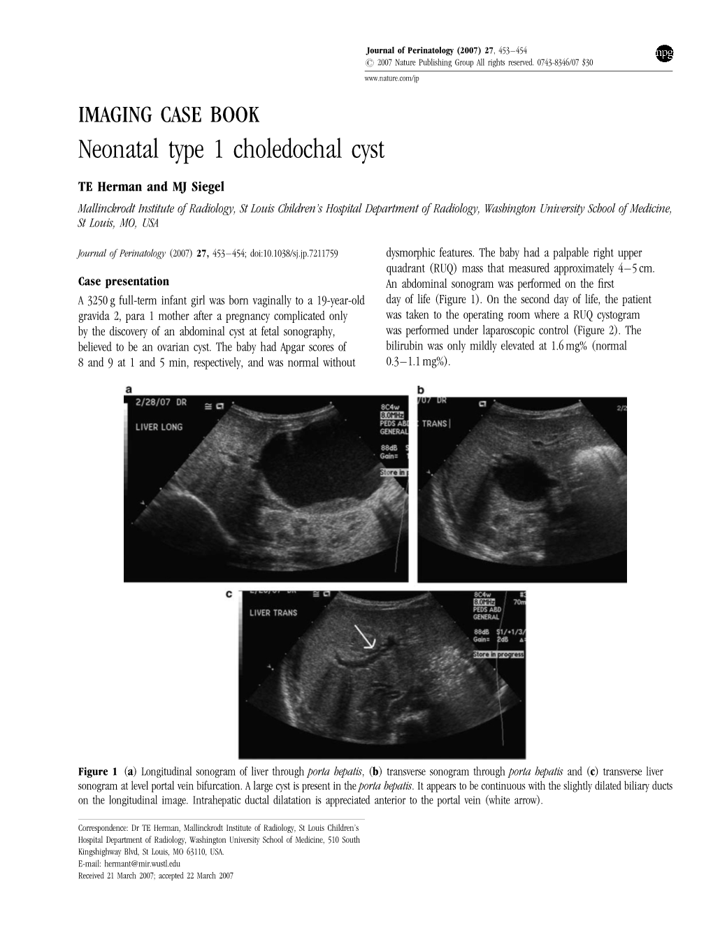 Neonatal Type 1 Choledochal Cyst