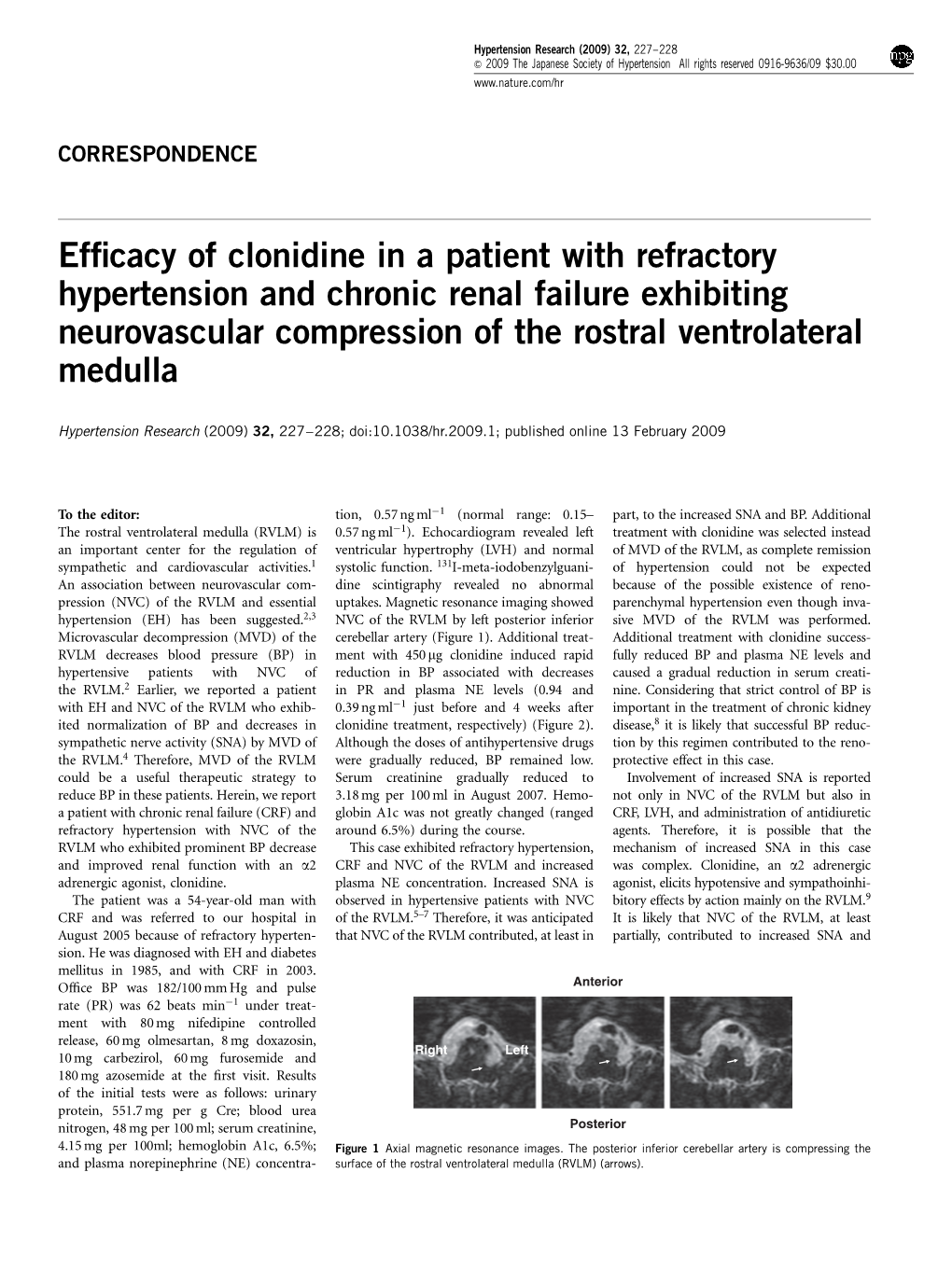 Efficacy of Clonidine in a Patient with Refractory Hypertension and Chronic Renal Failure Exhibiting Neurovascular Compression O