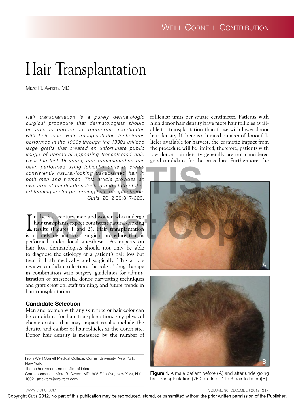 Hair Transplantation