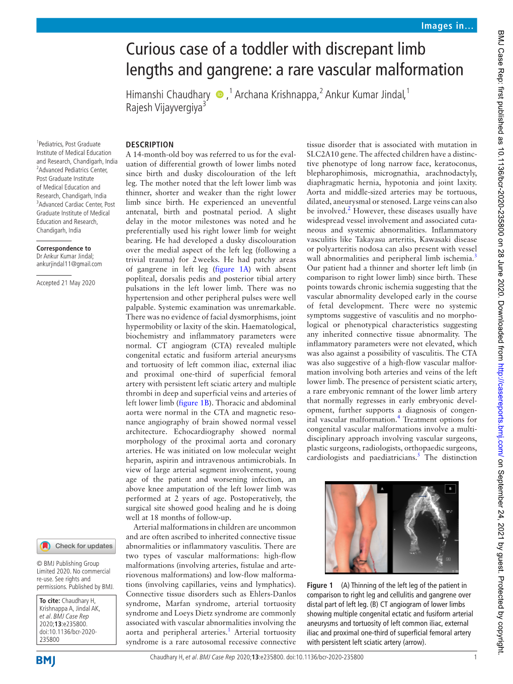 A Rare Vascular Malformation Himanshi Chaudhary ‍ ‍ ,1 Archana Krishnappa,2 Ankur Kumar Jindal,1 Rajesh Vijayvergiya3