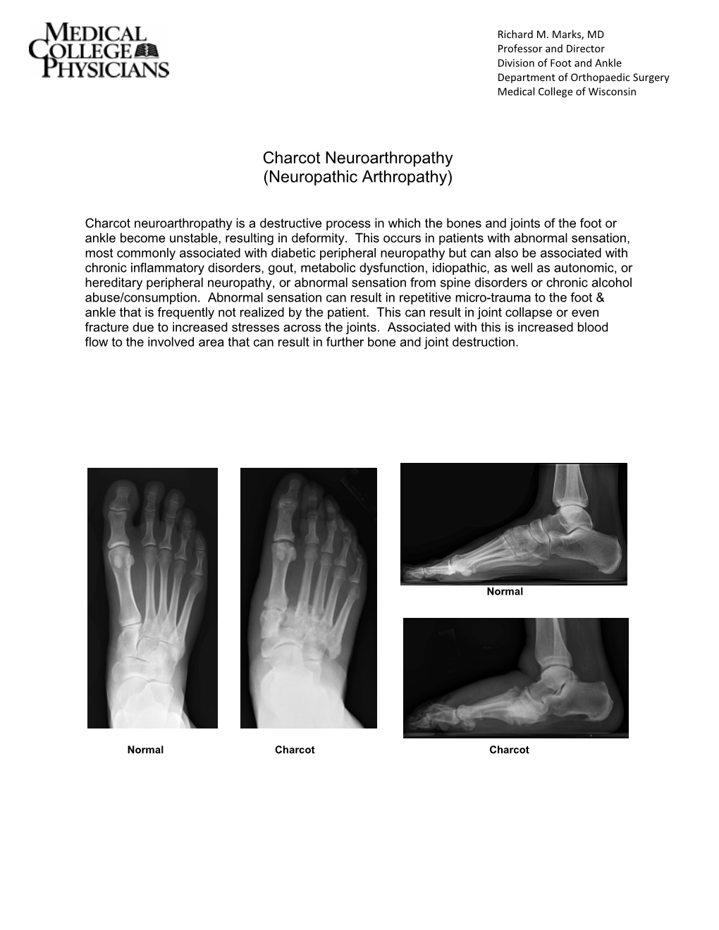 Charcot Neuroarthropathy (Neuropathic Arthropathy)