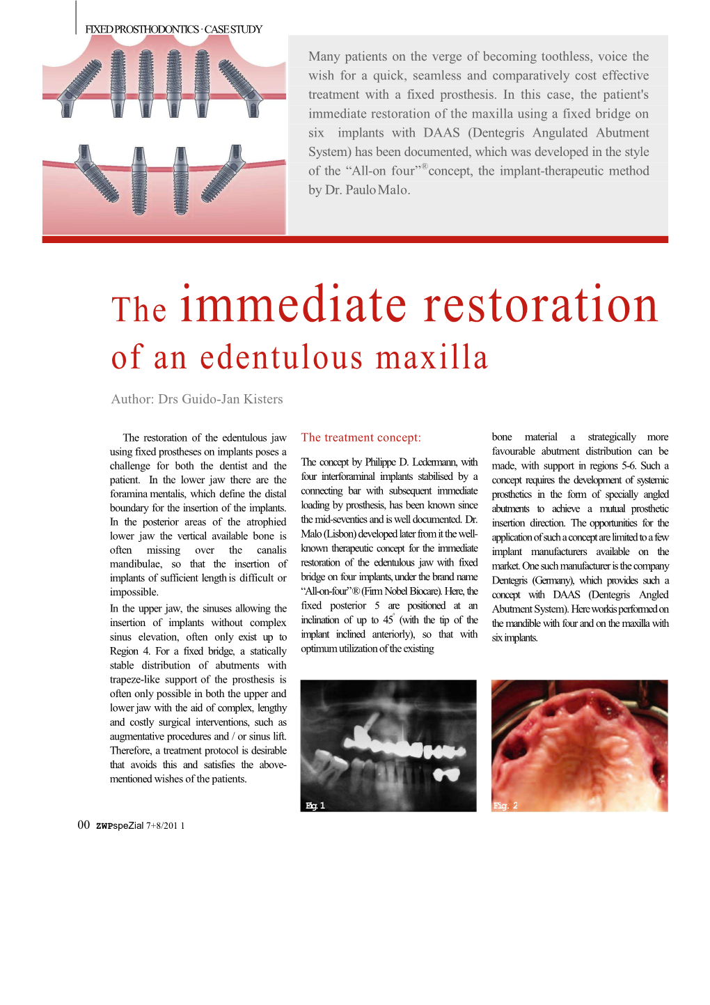 The Immediate Restoration of an Edentulous Maxilla