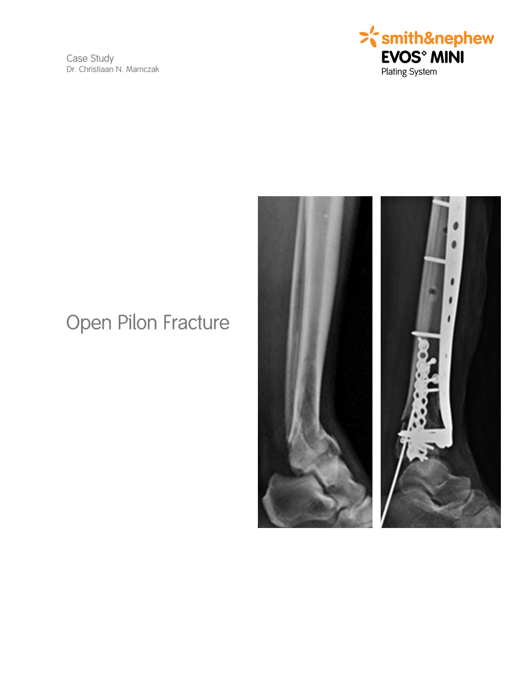 Open Pilon Fracture Patient Information • 50-Year-Old Female