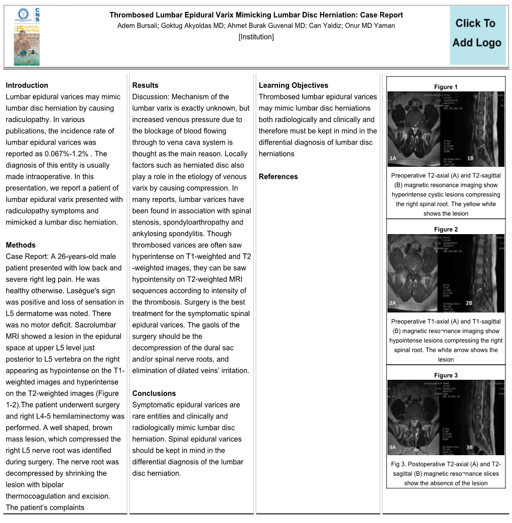 Thrombosed Lumbar Epidural Varix Mimicking