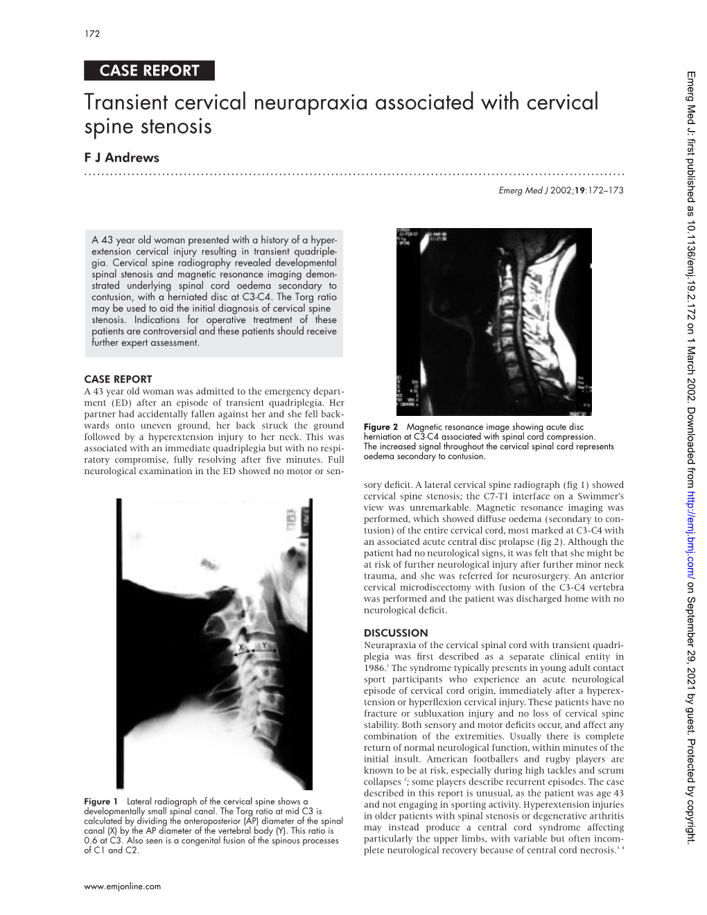 Transient Cervical Neurapraxia Associated with Cervical Spine Stenosis F J Andrews